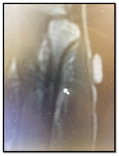 perry-stress-fracture-x-ray